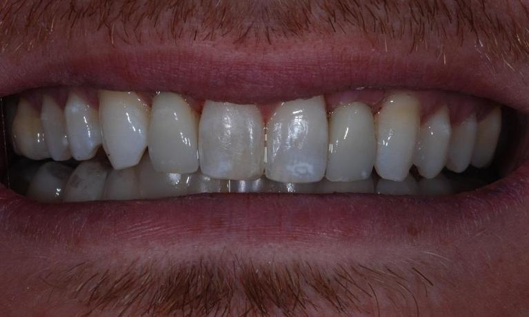 Implants-After-Image