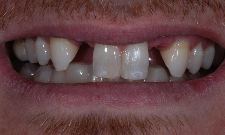 Implants-Before-Image
